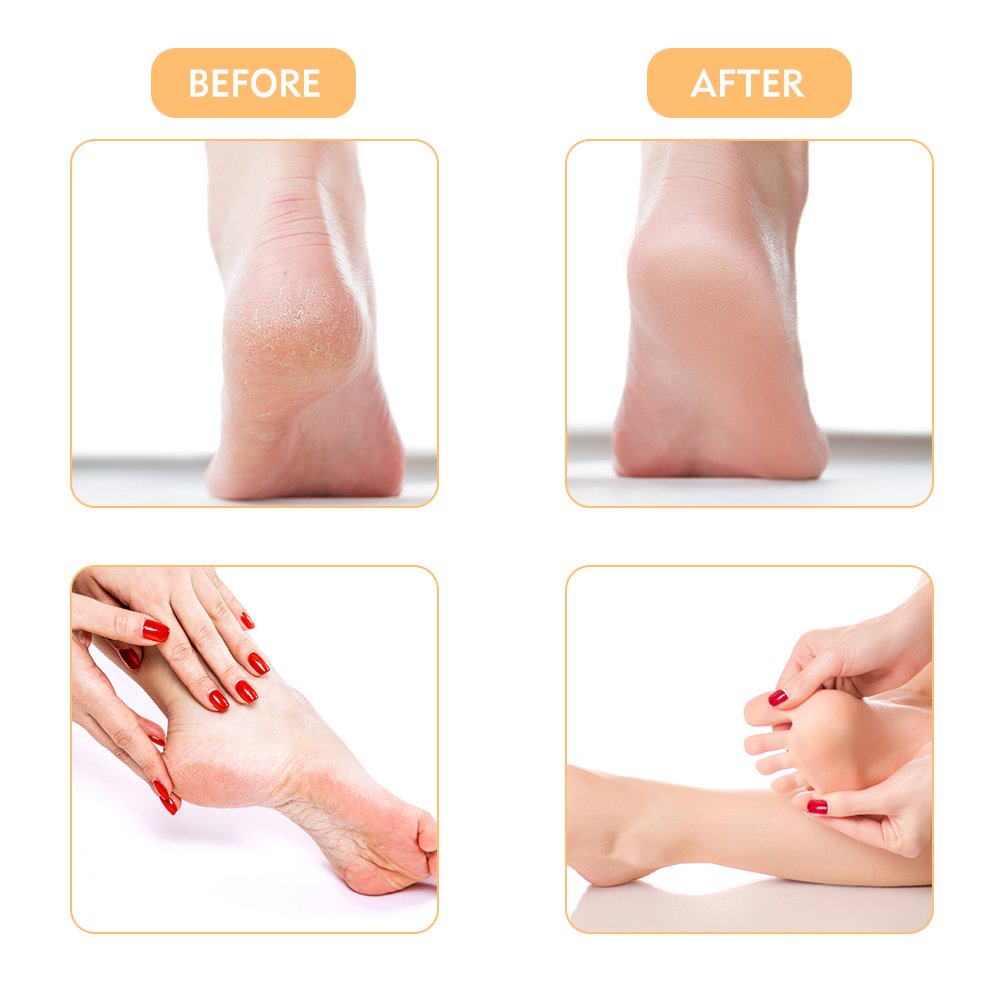 Electric Callus Remover, Rechargeable Foot File Hard Skin Remover Pedicure Tools for Feet Electronic Callus Shaver Waterproof Pedicure kit for Cracked Heels and Dead Skin with 2 Roller Heads
