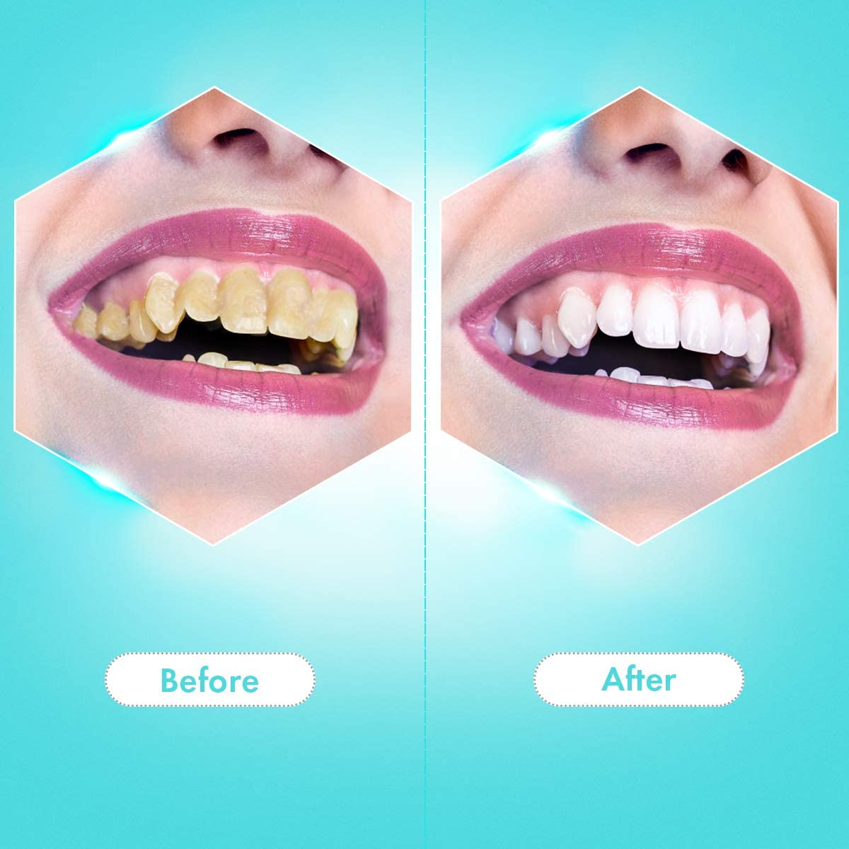 Plaque Remover for Teeth, Ultrasonic Tooth Cleaner Tartar Remover, Electric Teeth Cleaning Kit Tooth Stain Calculus Remover 2 in 1 Toothbrush Cleaning, Safe for Adult and Kids，Dental Calculus，calculus teeth，dental plaque，snow teeth whitening