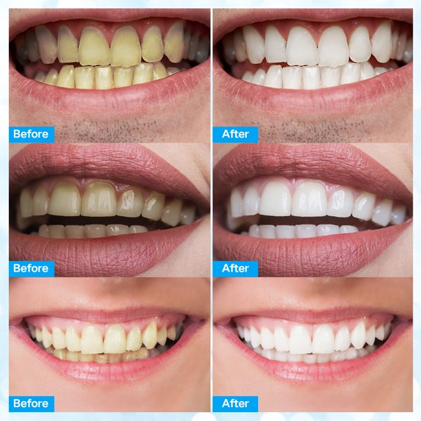 Teeth Whitening Kit,16x LED Light Without Sensitive With 5 Smart Teeth Whitening Pens 3 Teeth Whitening Strips,Effectively Whitens in 30 Minutes,White